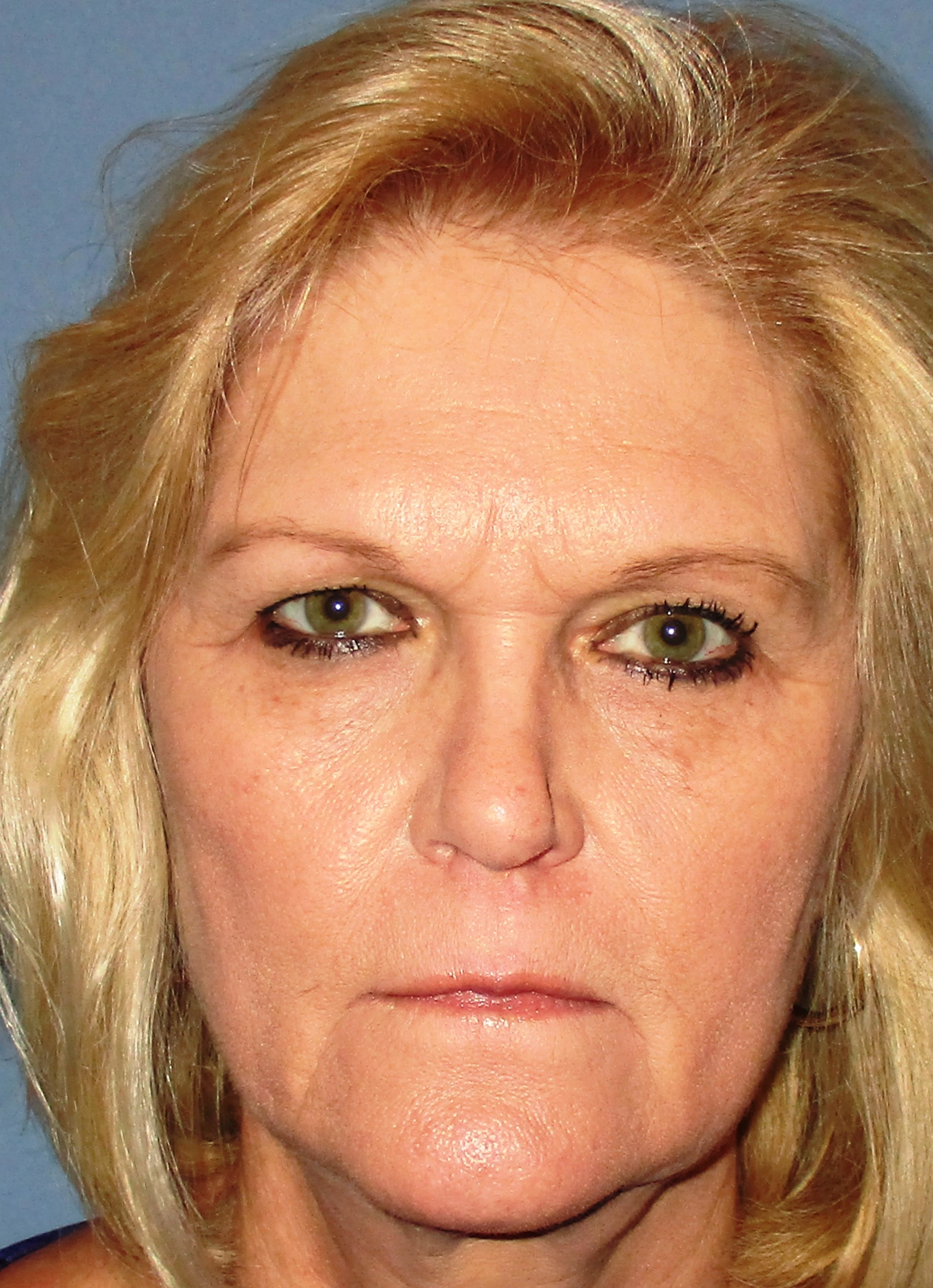 Browlift Before Photo