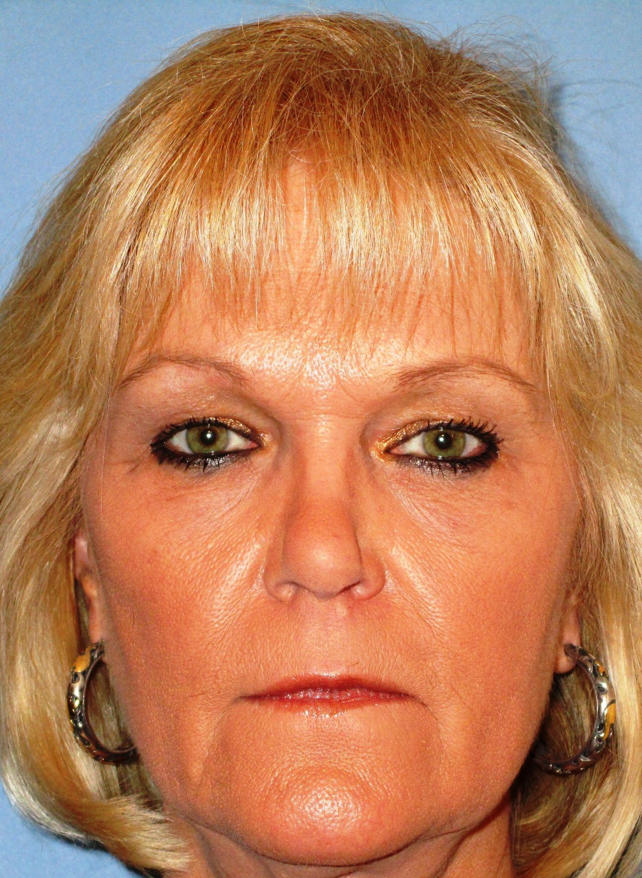 Browlift After Photo