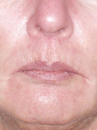 Lip Before Photo